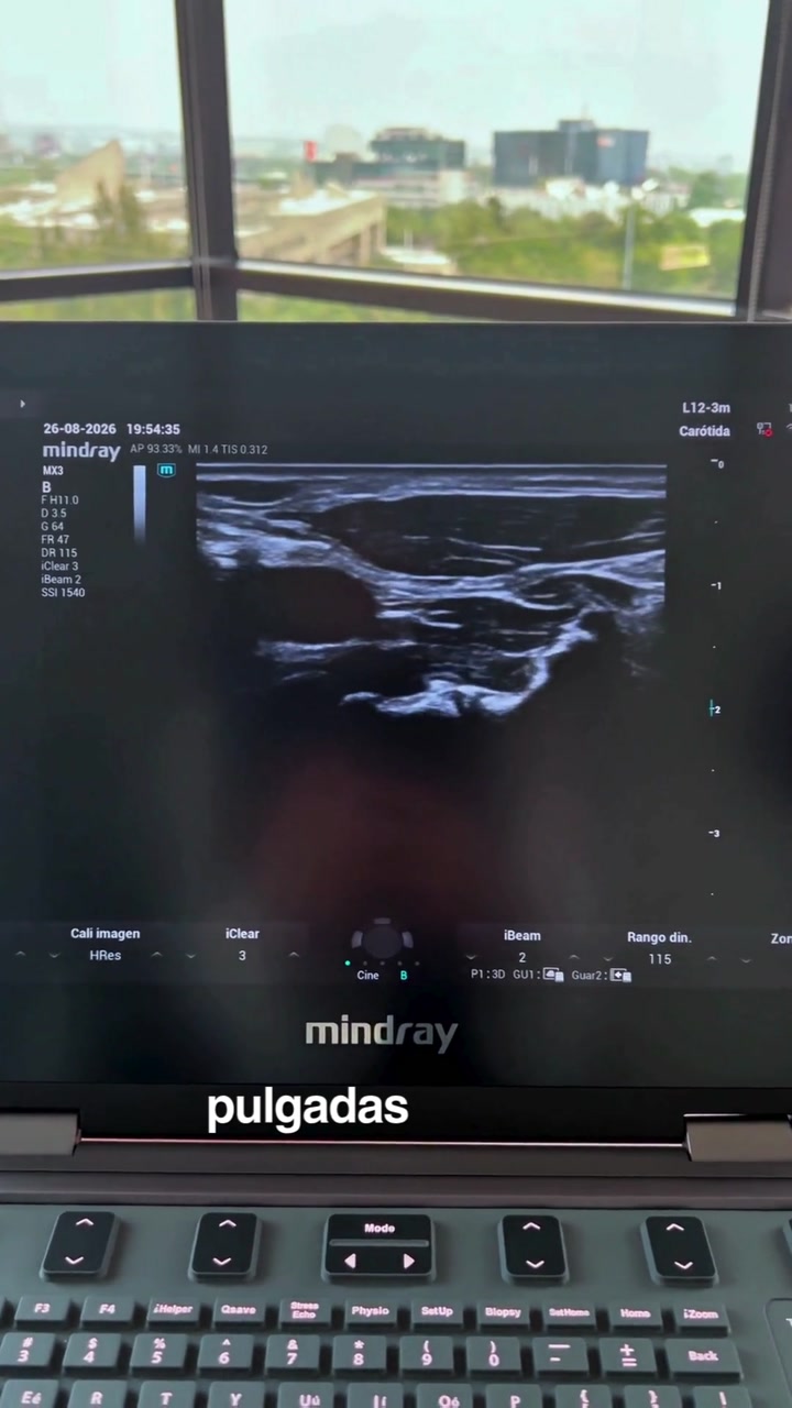 Mindray MX3: Pantalla